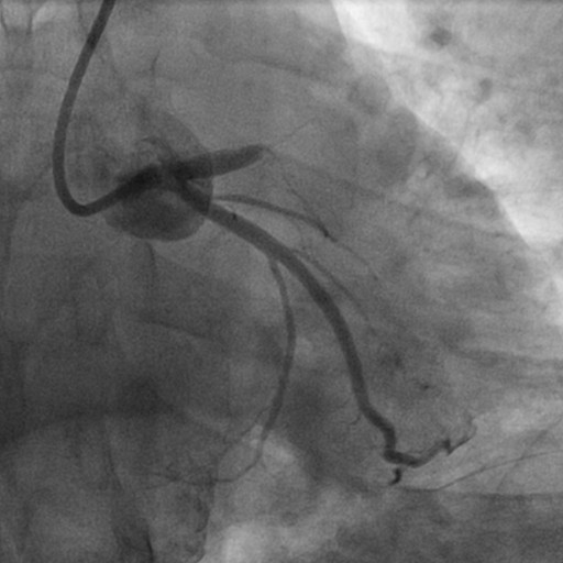 Rescue PCI in an Extensive AMI in a 30 Year Old Male | tctmd.com