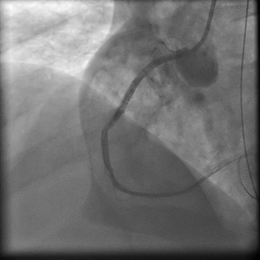 Successful Treatment of Coronary Artery Perforation with Hand-Made ...