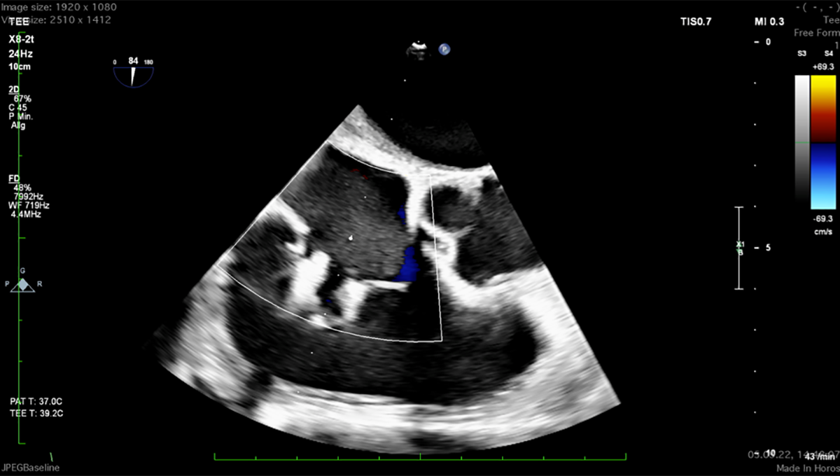Higher Gradient After Tricuspid TEER Not Harmful at 1 Year: TriValve Registry - Vimarsana News