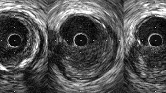 For Complex PCI, Intravascular Imaging Lowers Risk of Target Vessel Failure - Vimarsana News