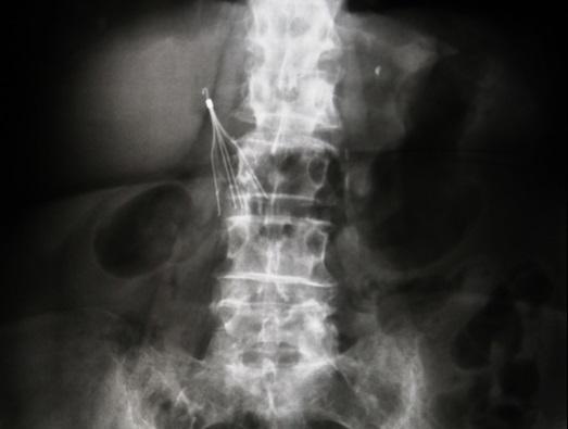 Inferior Vena Cava Filters: The Longer They’re In, the Higher the Risk of Adverse Events