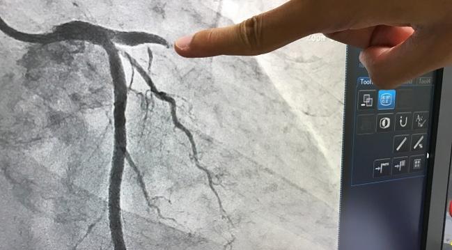 Ad Hoc PCI Safe and Feasible in Patients Undergoing TAVR