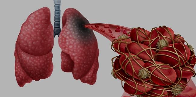 German COVID-19 Autopsy Data Show Thromboembolism, ‘Heavy’ Lungs