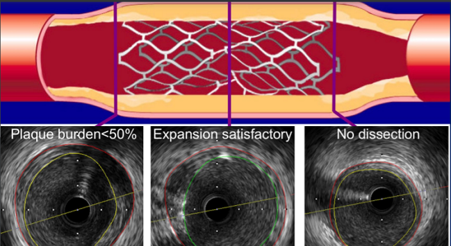 IVUS-Guided PCI Gains Support With Longer-Term ULTIMATE Results