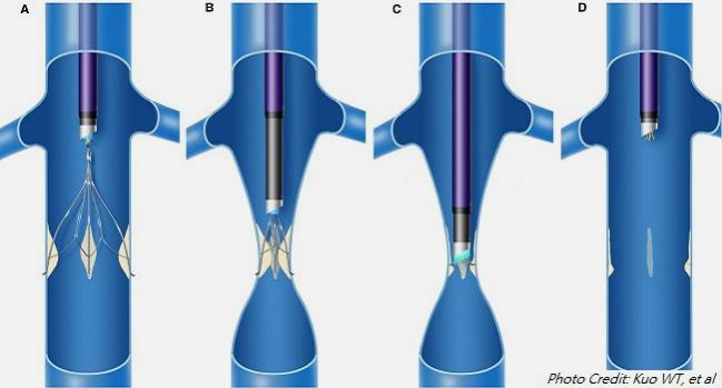 Lasers Can Aid Retrieval of Stubborn IVC Filters