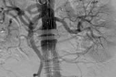 EVAR Shown to IMPROVE Outcomes Over Surgery for Ruptured AAA Patients 