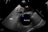Atrial Septal Aneurysm, Not Shunt Size, Tied to Recurrent PFO-Related Stroke