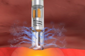 PRECEPT Provides Support for Ablation of Symptomatic, Persistent A-fib
