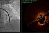 ‘Aggressive’ OCT Strategy for Stent Sizing Noninferior to IVUS: iSIGHT