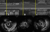 VAMPIRE 3: Attenuated Plaque May Signal Benefit of Thrombus Removal in PCI